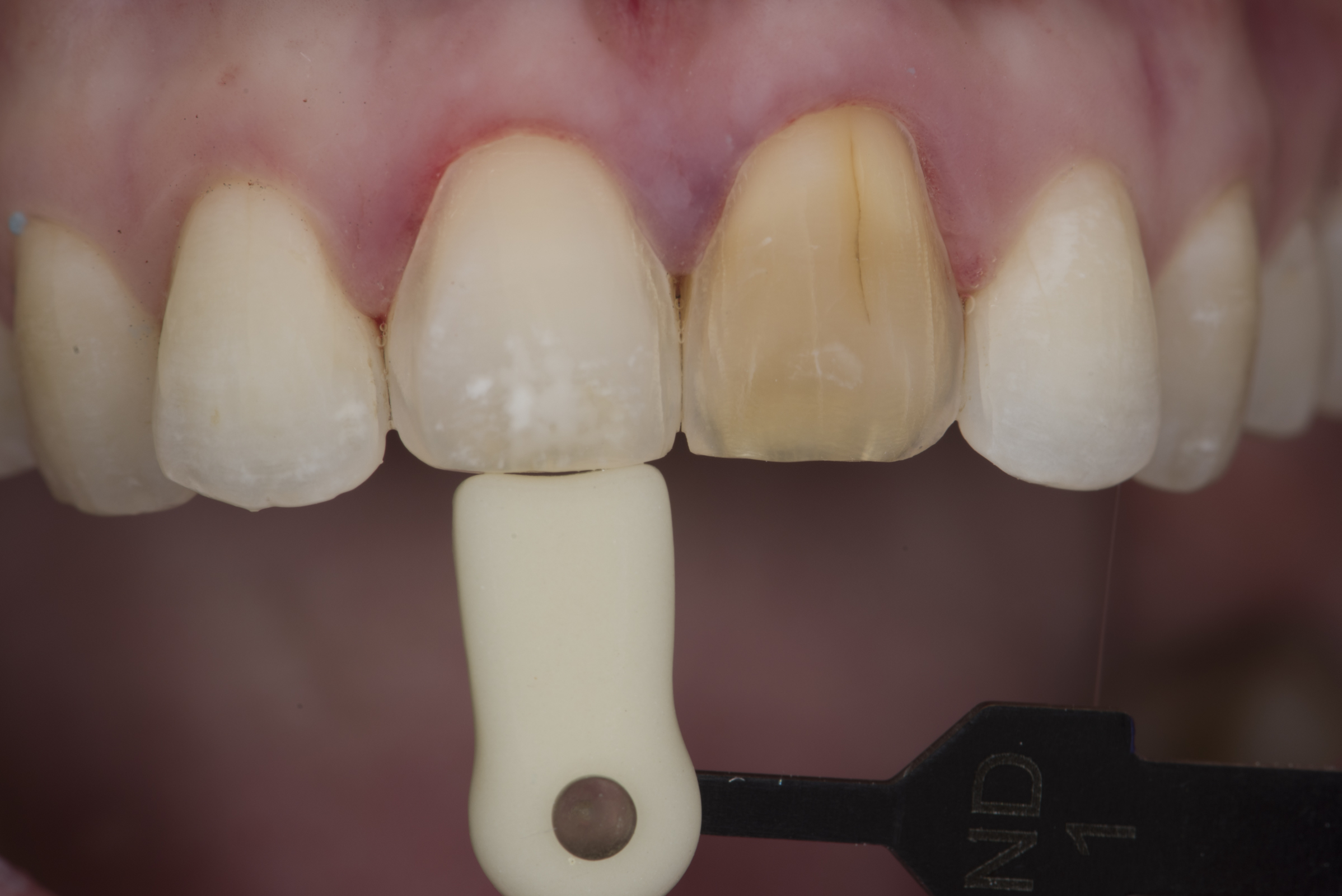 Facings - Kwalident Dental Studio