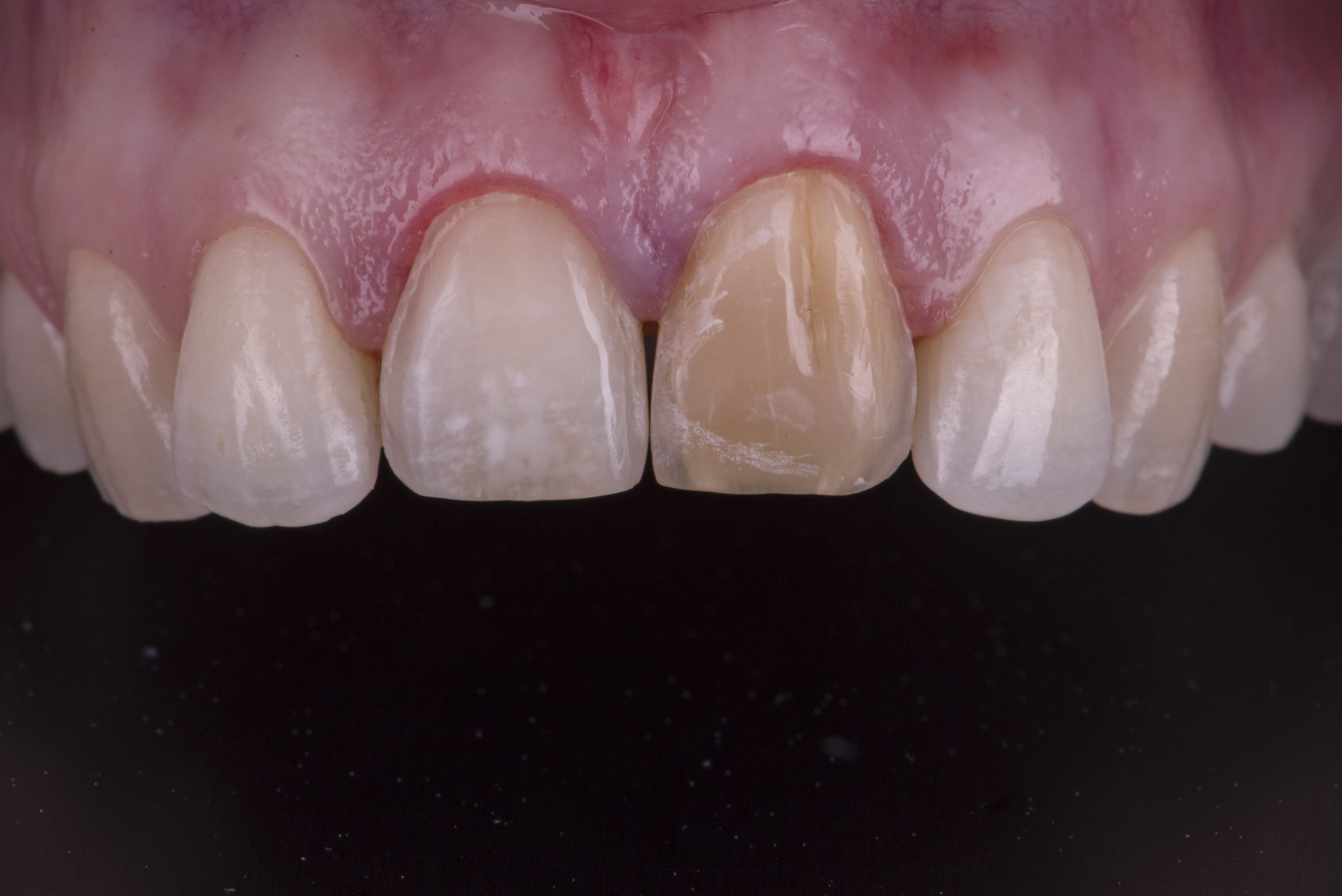 Facings - Kwalident Dental Studio